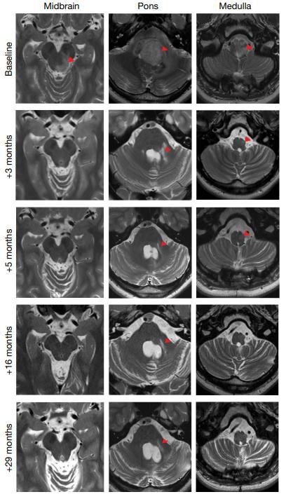 CAR-T Cells Show Dramatic Response in H3K27M Midline Glioma.jpg